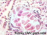 Kidney CMV giant cells